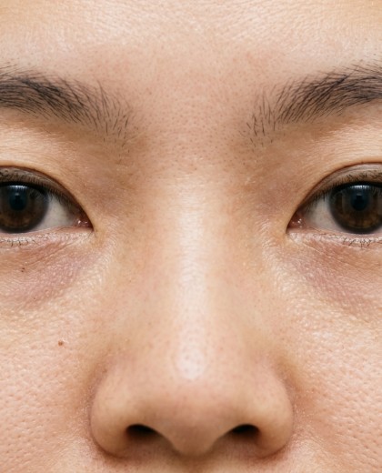 小雯 双眼皮术前