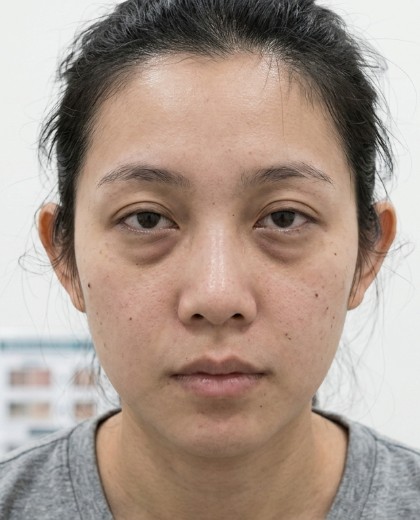 Amanda 去眼袋术前