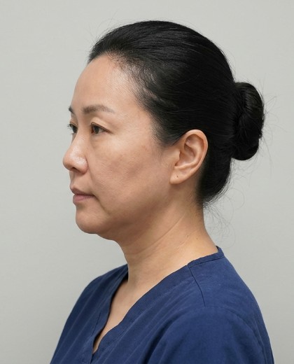 Rachel 去双下巴术前